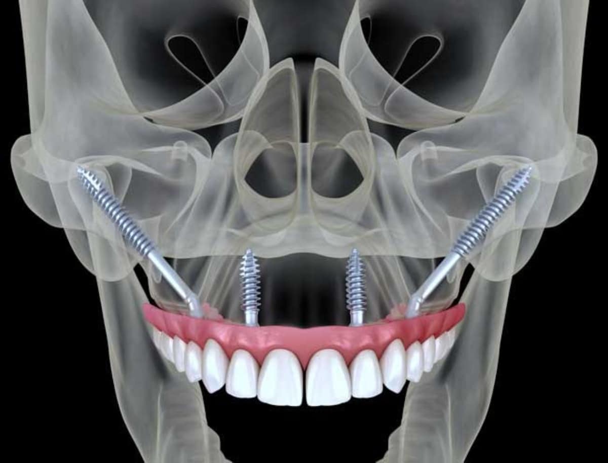 are-dental-implants-an-option-if-i-ve-suffered-jaw-bone-loss